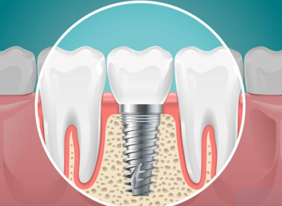 Dental implants